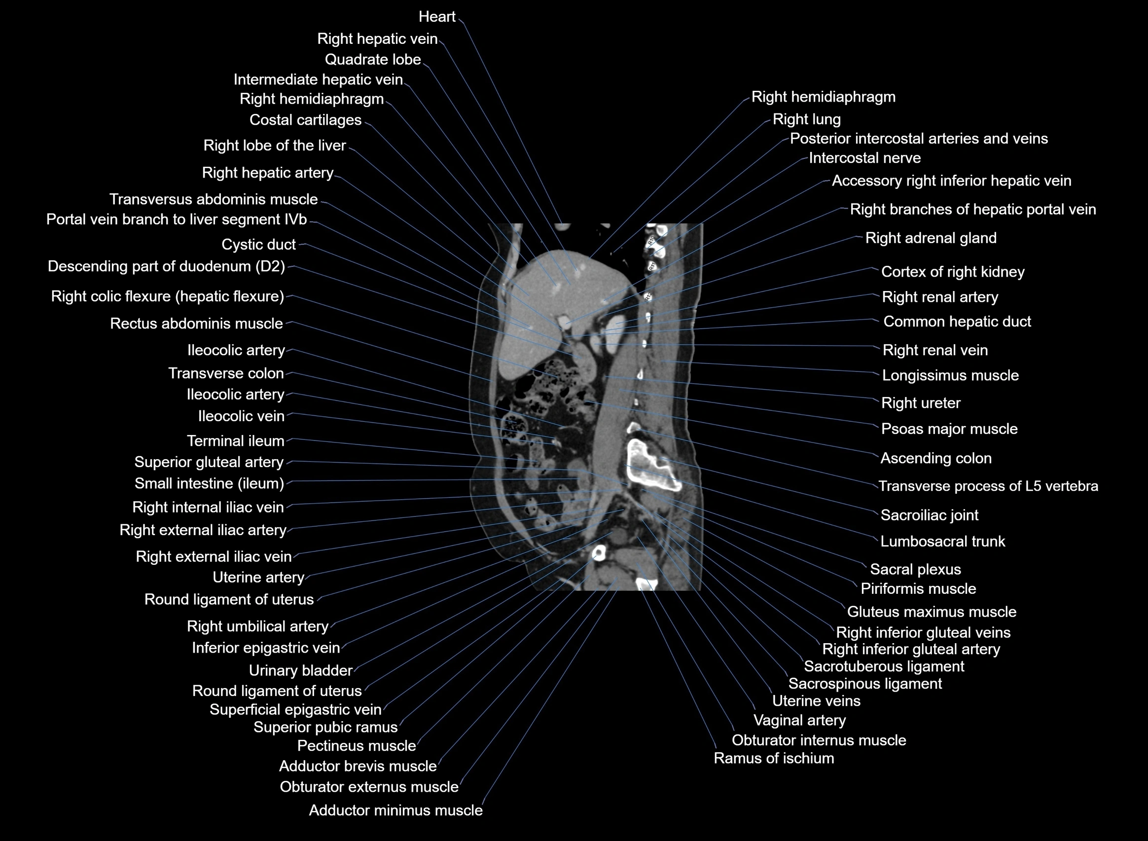 CT Abdomen sagittal cross sectional anatomy labelled radiology image -00073.webp